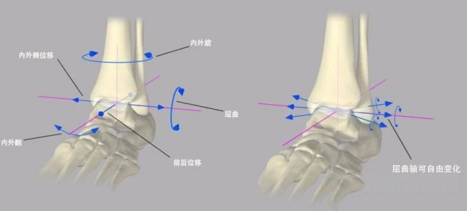 【醫療器械】人工踝關節假體設計