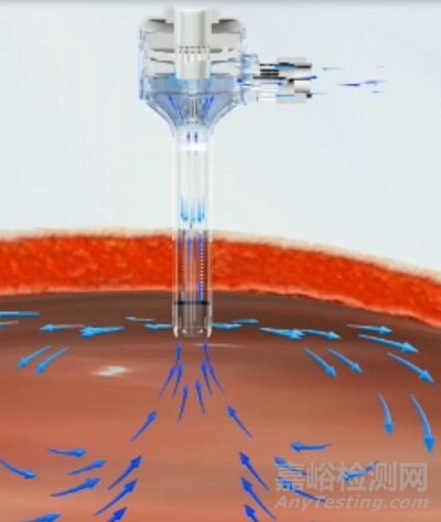 一次性使用腹部穿刺器注冊審查指導原則征求意見稿發布（附全文）
