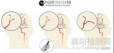 TIGERTRIEVER13：最小取栓支架 開啟腦遠端區域卒中治療