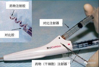 首個獲FDA授予突破性設(shè)備的干細(xì)胞治療心衰產(chǎn)品