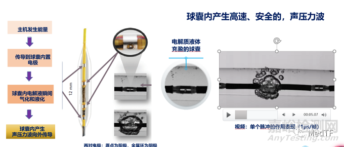 Shockwave IVL血管內(nèi)沖擊波產(chǎn)品獲NMPA批準(zhǔn)