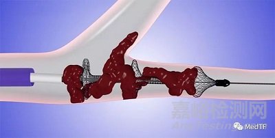 英納瑞創新醫械 “肺動脈取栓系統”技術解析