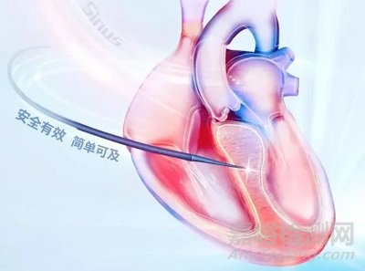 賽納思醫(yī)療創(chuàng)新經(jīng)導管室間隔心肌內射頻消融系統(tǒng)技術解析