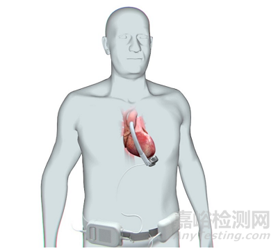 【創新醫械】基于獨特波浪膜技術的左心室輔助裝置