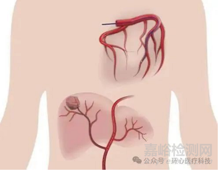 國產(chǎn)首款可控彎微導(dǎo)管獲批上市