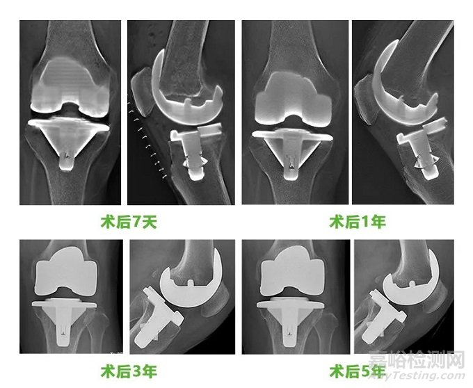 嘉思特創(chuàng)新醫(yī)械生物型膝關(guān)節(jié)假體系統(tǒng)技術(shù)解析